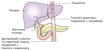 Tipuri de operații pentru cancerul gastric (tipuri) Tipuri de operații pentru cancerul gastric