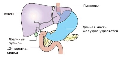 Tipuri de operații pentru cancerul gastric (stomac) Tipuri de operații pentru cancerul gastric