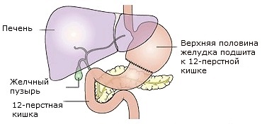 Tipuri de operații pentru cancerul gastric (operațiuni) Tipuri de operații pentru cancerul gastric
