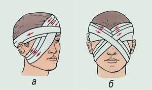 În unele cazuri, un plasture ochi medical (utilizate) În unele cazuri, un bandaj medical pe ochi