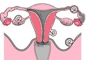 Sarcina ectopică (sarcini extrauterine) sarcină ectopică