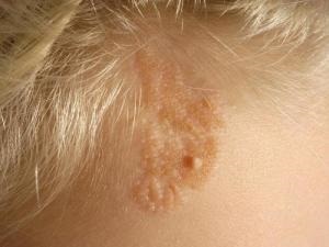 pigmentară intradermic nevii și nevokletochny ce este (pigment) pigmentară nevi intradermic și nevokletochny ce este