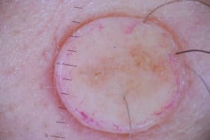 pigmentară intradermic nevii și nevokletochny ce este (pigment) pigmentară nevi intradermic și nevokletochny ce este