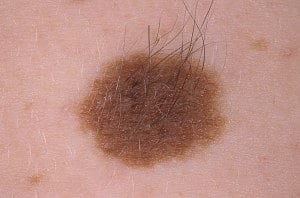 pigmentară intradermic nevii și nevokletochny ce este (pigment) pigmentară nevi intradermic și nevokletochny ce este