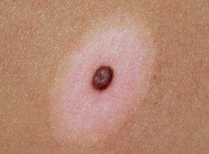 pigmentară intradermic nevii și nevokletochny ce este (nevii) pigmentară nevi intradermic și nevokletochny ce este