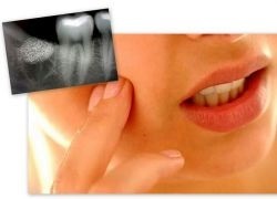Inflamația periostului cauze, tratament (inflamație) Inflamația periostului cauze, tratament