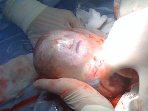 Deschiderea membranelor (bule) Autopsy membranelor