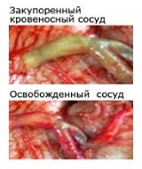 plăci de colesterol din artera carotida ca clară și dacă să se dizolve (carotide) plăci de colesterol în artera carotidă, ca clară și dacă să se dizolve