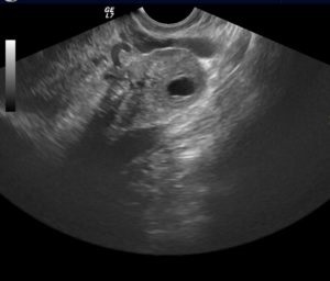 Corpus luteum in ovar, care este (corpul) Corpus luteum in ovar, este