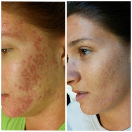 azot lichid în produsele cosmetice pentru față, atunci când procedura prescrisă, contraindicații, fotografia înainte și după (cosmetologie) Azotul lichid în produsele cosmetice pentru față, atunci când procedura prescrisă, contraindicații, fotografii înainte și după