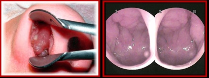 Vegetatiilor adenoide arata ca in nas (vegetații adenoide copil nas) Vegetatiilor adenoide arata ca in nas