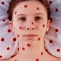 Dieta pentru urticarie la adulti, care pot fi consumate și ceea ce nu este (adulți) Dieta pentru urticarie la adulti, care pot fi consumate și ce nu este