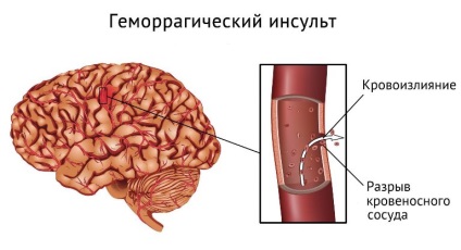 Accident vascular cerebral și consecințele sale este viața după „eșec“