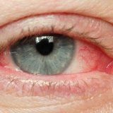 infecții oculare virale acute si cronice - medicul dumneavoastră Aibolit (ochi) infecții oculare virale acute si cronice - medicul dumneavoastră Aibolit