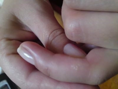 Acnee pe degete (coșuri) Acnee pe degete