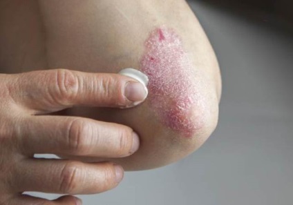 Psoriazisul pe simptomele coate, tratament si foto (psoriazis) Psoriazisul pe simptomele coate, tratament și fotografii