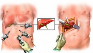 Calculii mai periculoase, de recuperare a nanotehnologiei de sanatate, fara medicamente (pentru a dizolva pietrele din vezica biliară) Calculii mai periculoase, nanotehnologie de sănătate de recuperare fără medicamente
