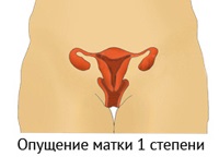 Prolapsul uterin la femei periculoase (uter) Prolapsul uterin la femei periculoase