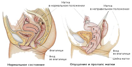 Prolapsul uterin periculos la femei (femei) Prolapsul uterin la femei periculoase