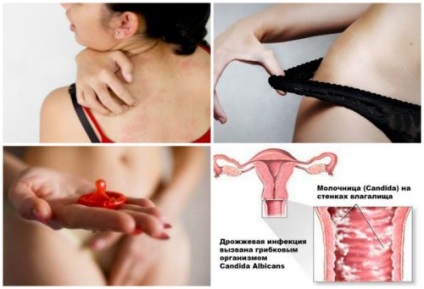 Сърбеж (пруритус) в слабините на причините за жените, симптоми, лечение