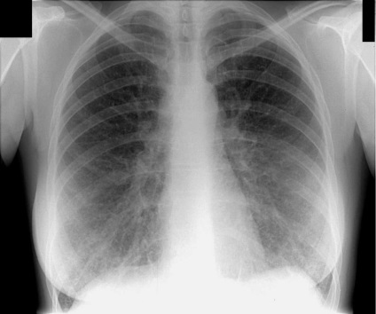 Diagnosticarea bronșită (auscultare medicul cere) diagnosticul de bronșită