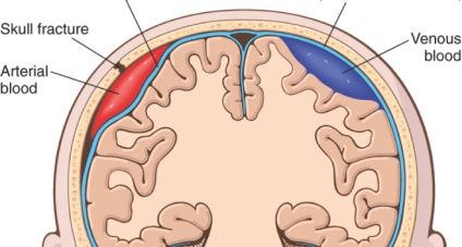 Епидурален хематом на мозъка