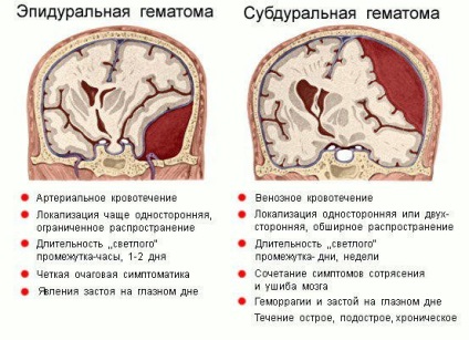 Епидурален хематом на мозъка ефекти, лечението, симптомите