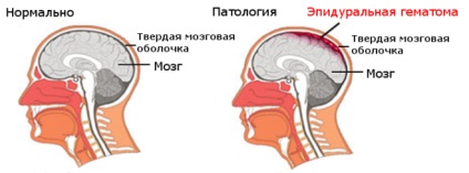 Епидурален хематом на мозъка симптоми и лечение