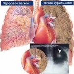 Cangrena fumat (afectează organismul uman) cangrena fumat