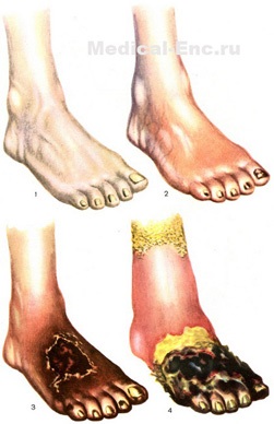 Cangrena fumat (metoda de fumat renuntat) cangrena fumat