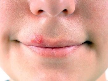 Herpes pe buze (primele simptome) Herpes pe buze