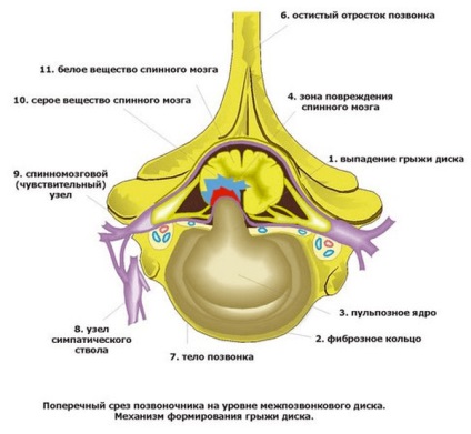 chirurgie hernie spinal, efectele (operare) chirurgie hernie spinării, efectele