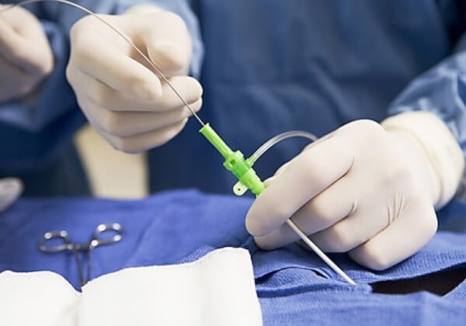 chirurgie hernie spinării, efectele (coloanei vertebrale) chirurgie hernie spinării, efectele
