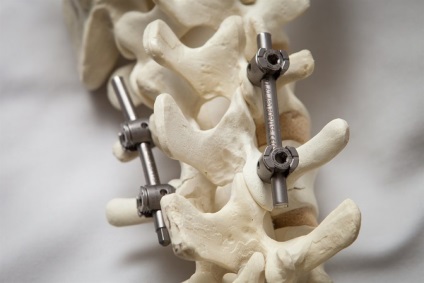 Implanturile pentru coloana vertebrala (coloana vertebrală) implanturile Spine