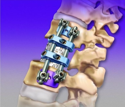 Implanturi pentru a coloanei vertebrale (implanturi) implanturile Spine