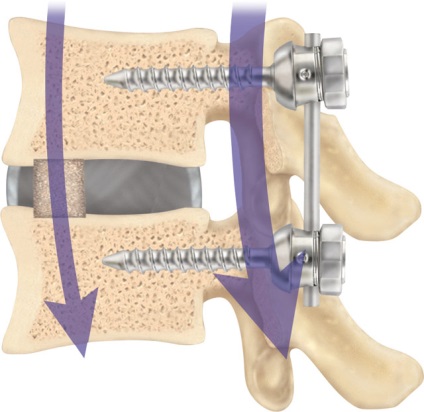 Implanturi pentru a coloanei vertebrale (implanturi) implanturile Spine