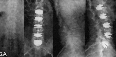 Implanturile pentru coloana vertebrala (coloana vertebrală) implanturile Spine