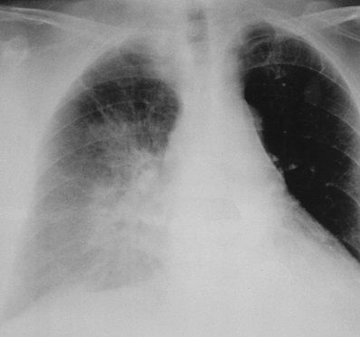 infarct miocardic (un nou simptome vizuale) infarct miocardic