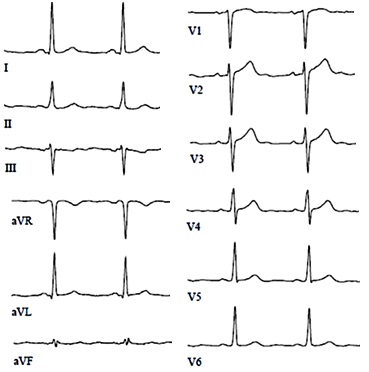 infarct miocardic (atac de cord) infarct miocardic