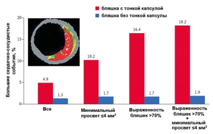 infarct miocardic (tulburări de miocard viabil locale) infarct miocardic