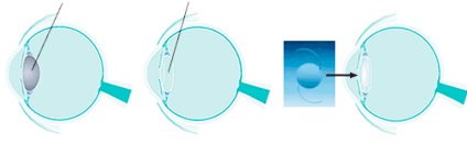 Cataracta - centrul de chirurgie ochi (ochi chirurgie) Cataracta - Chirurgie Eye Center