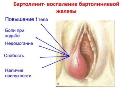 Chist Bartholin glanda, fara chirurgie, remedii populare (aleatoriu) Chist Bartholin glanda, fara chirurgie, remedii populare