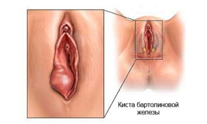 Chist Bartholin glanda, fara chirurgie, remedii populare (inflamație) Chist Bartholin glanda, fara chirurgie, remedii populare