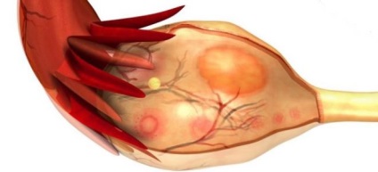 chist luteal in timpul sarcinii (corpus luteum) chist luteal in timpul sarcinii