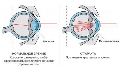 Tratamentul cataractei la Moscova (Moscova) Tratamentul cataractei la Moscova
