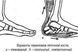 picioare tratament fractură picior (tratament) Tratamentul fracturii piciorului piciorului