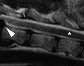 hernie intervertebral simptome câini și tratament, despre câini (simptome) hernie intervertebral simptome câini și tratament, totul despre câini