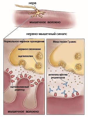 Миастения гравис фото