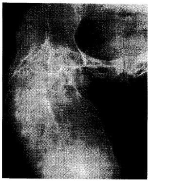 Osteogenezei imperfecta 2 (osteomielita) Osteogeneza imperfecta 2