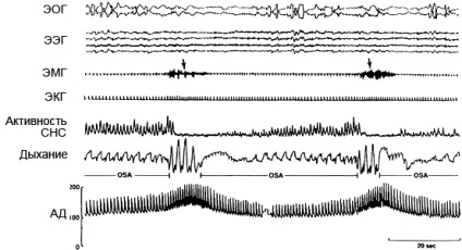 apnee obstructiva de somn (obstructive) apnee obstructiva de somn